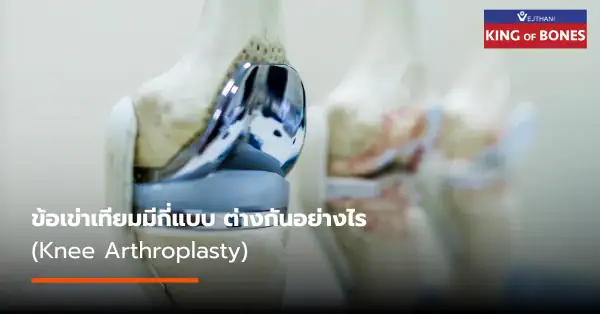 ข้อเข่าเทียมมีกี่แบบ ต่างกันอย่างไร