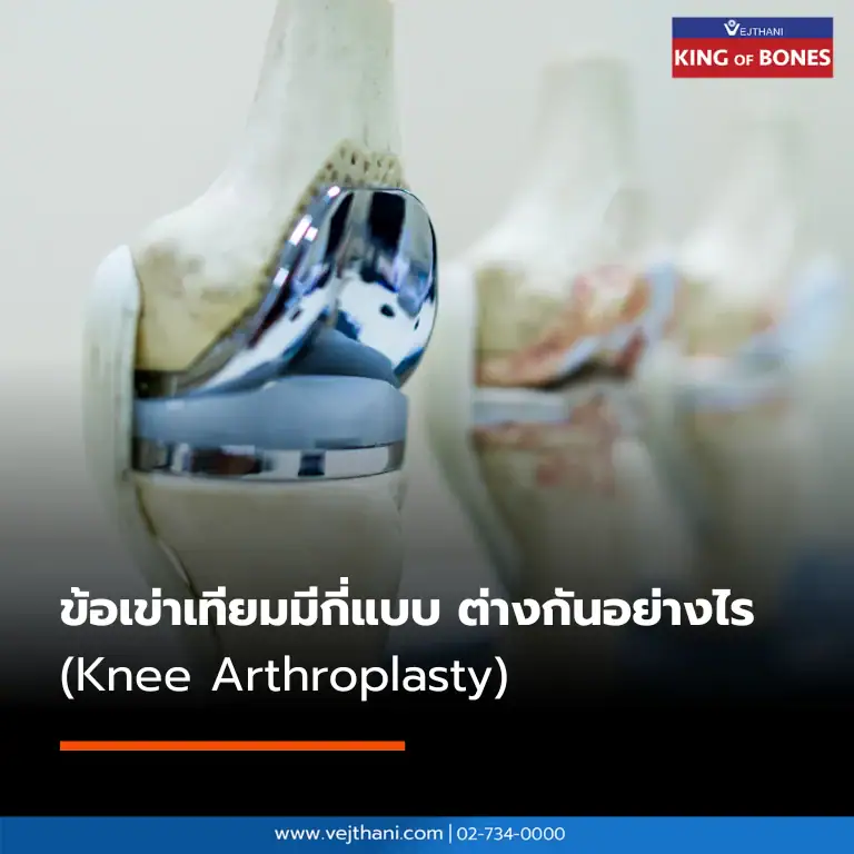 ข้อเข่าเทียมมีกี่แบบ ต่างกันอย่างไร