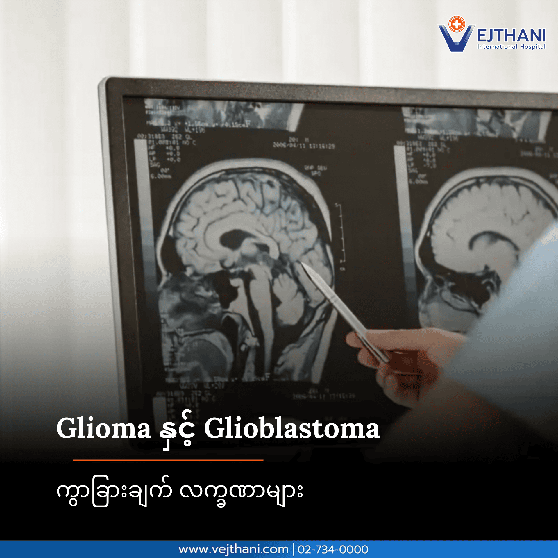 ဂလိုင်အိုးမား (Glioma)နှင့် ဂလိုင်အိုဗလက်စတိုးမား (Glioblastoma)