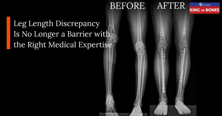 Leg Length Discrepancy