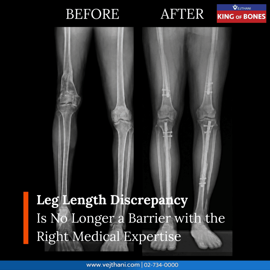 Leg Length Discrepancy