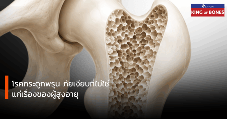 โรคกระดูกพรุน